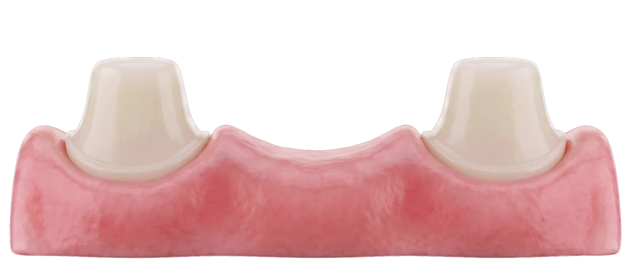 Two prepared teeth either side of a gap