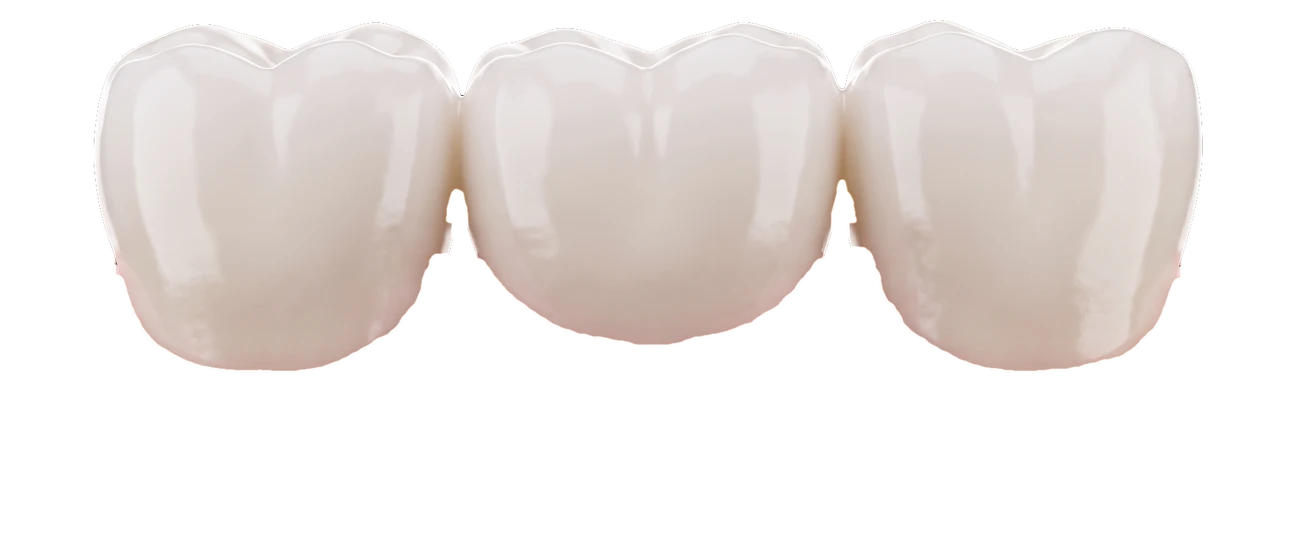Porcelain dental bridge